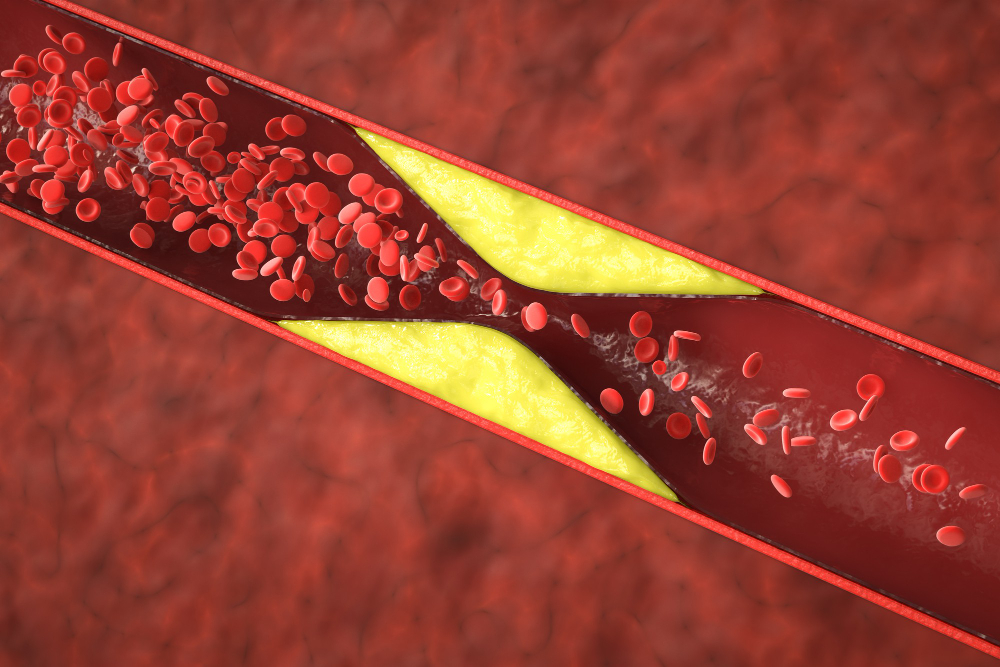 Carotid Artery Interventions